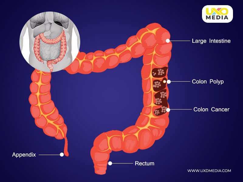 bowel cancer and treatment through ai