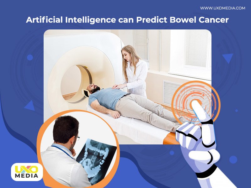 Artificial Intelligence can predict Bowel Cancer